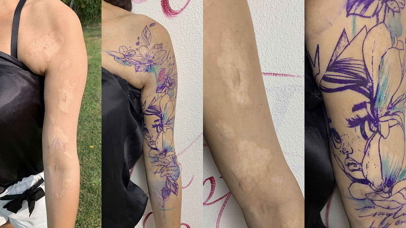SCAR COVER UP: covering a scar with a tattoo here's everything you need to  know - Lady Sara Tattoo